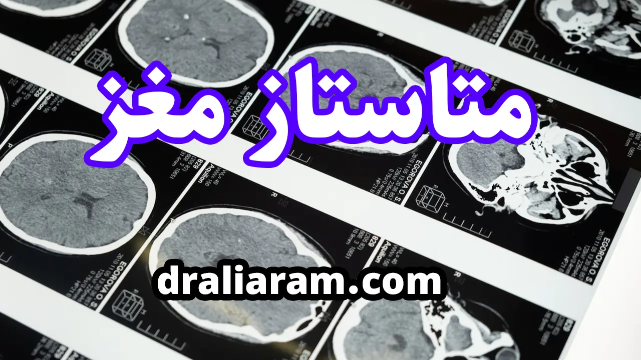 متاستاز مغز