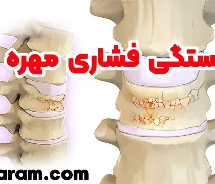 شکستگی فشاری مهره کمر