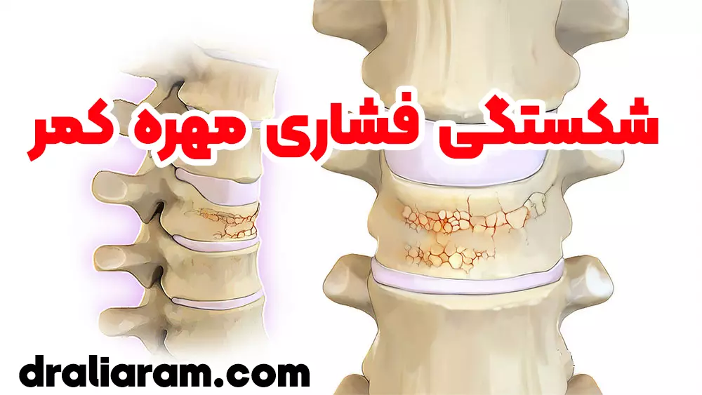 شکستگی فشاری مهره کمر