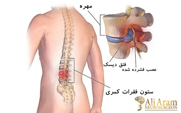 بعد از عمل دیسک کمر چه باید کرد؟