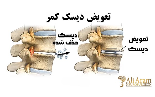 تمرینات مناسب برای بهبود حرکت و تقویت عضلات کمر