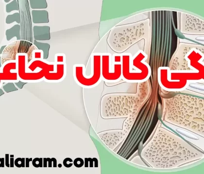 تنگی کانال نخاعی