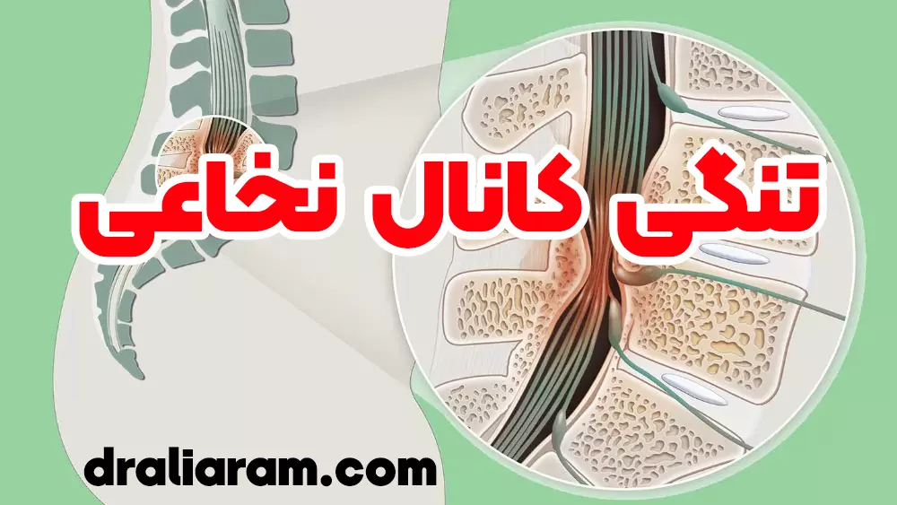تنگی کانال نخاعی
