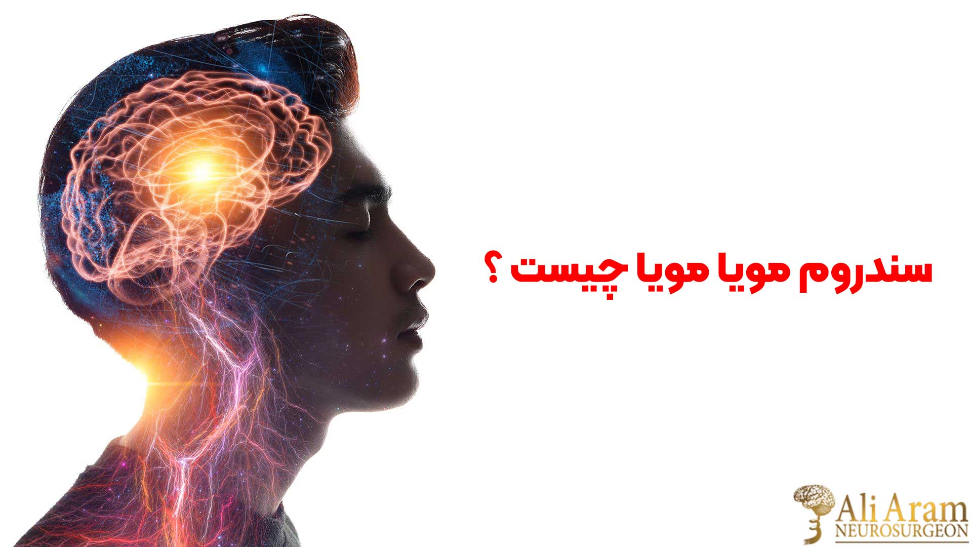 سندروم مویا مویا چیست ؟