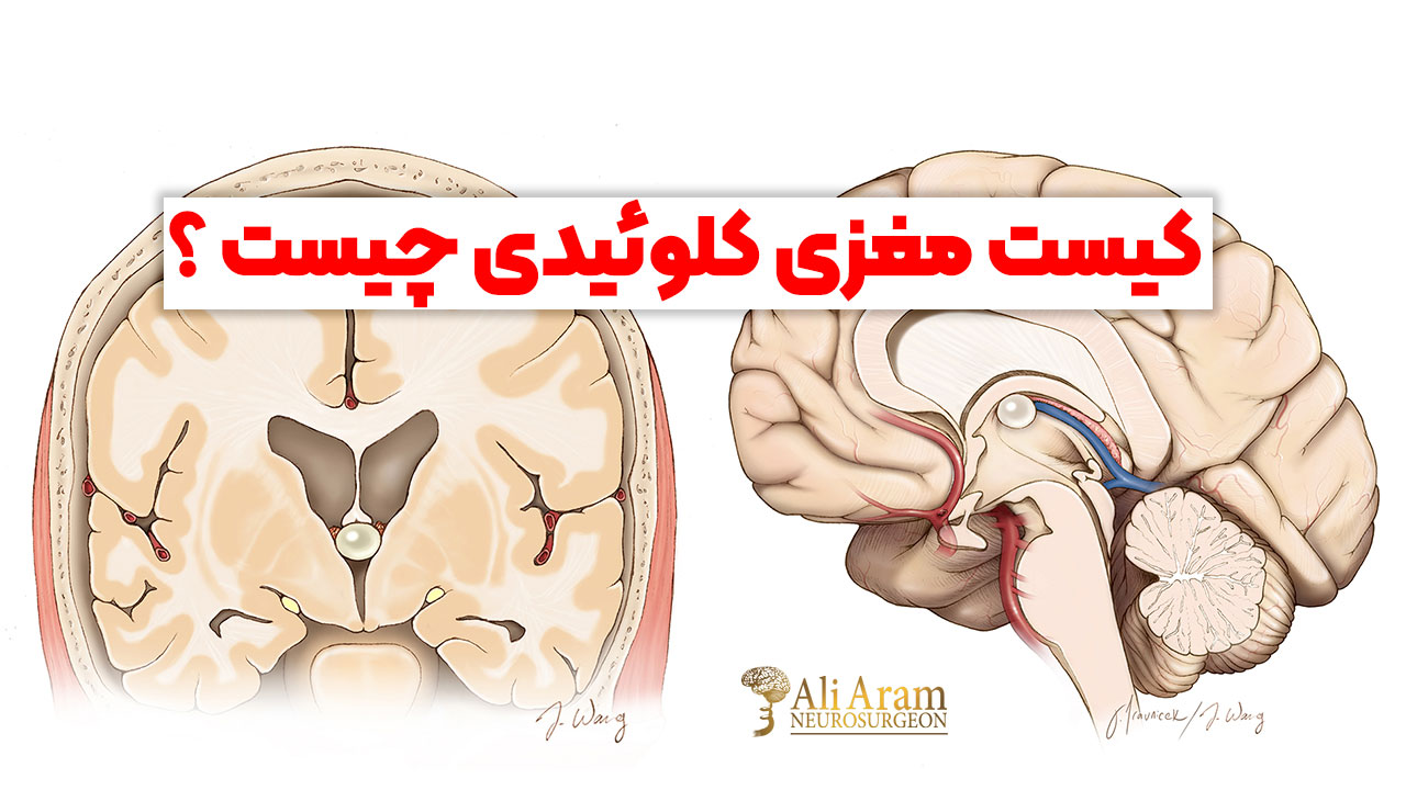 کیست مغزی کلوئیدی چیست ؟