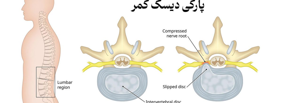 پارگی دیسک کمر