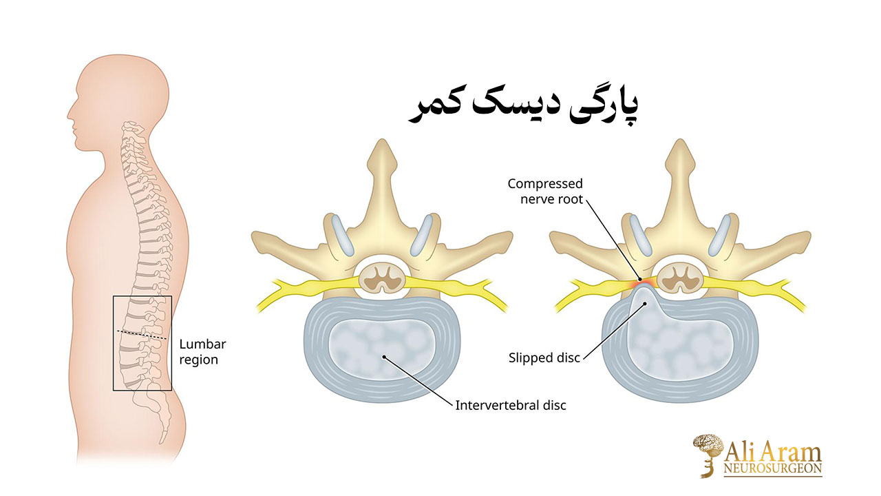 پارگی دیسک کمر