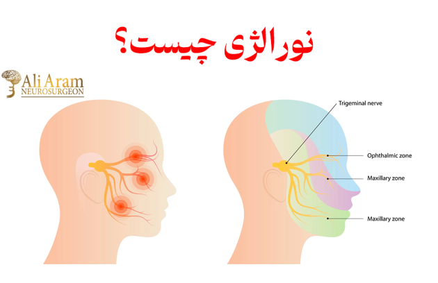 نورالژی چیست؟