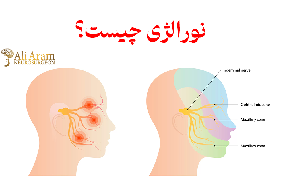 نورالژی چیست؟