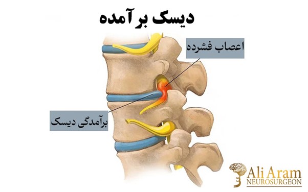 استراحت پس از جراحی دیسک گردن