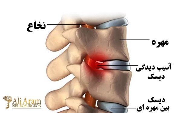 داروهایی که باید بعد از جراحی دیسک گردن مصرف کرد