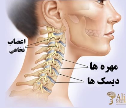 بعد از عمل دیسک گردن چه باید کرد؟