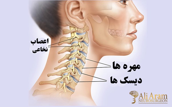 بعد از عمل دیسک گردن چه باید کرد؟