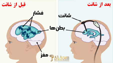 داروهای ضروری پس از جراحی شنت مغزی