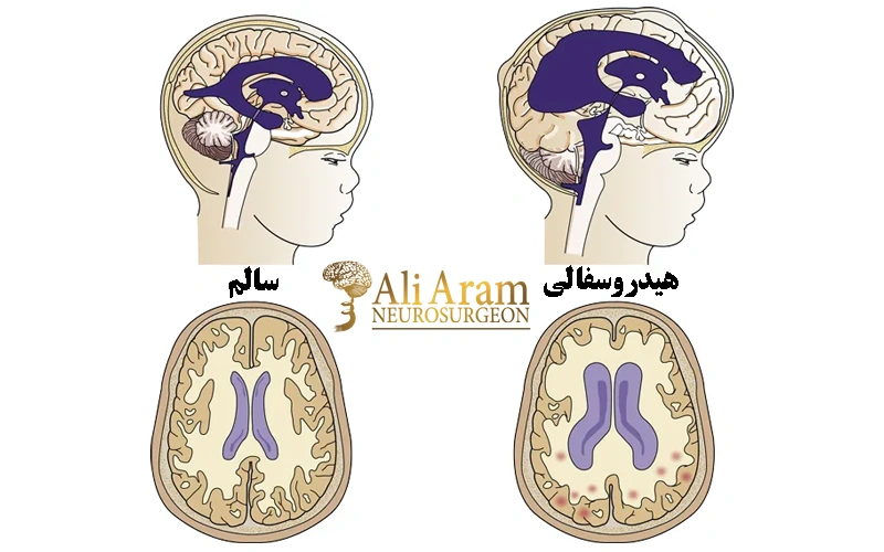 تشخیص هیدروسفالی