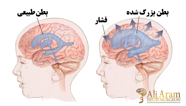 روش‌های درمانی هیدروسفالی