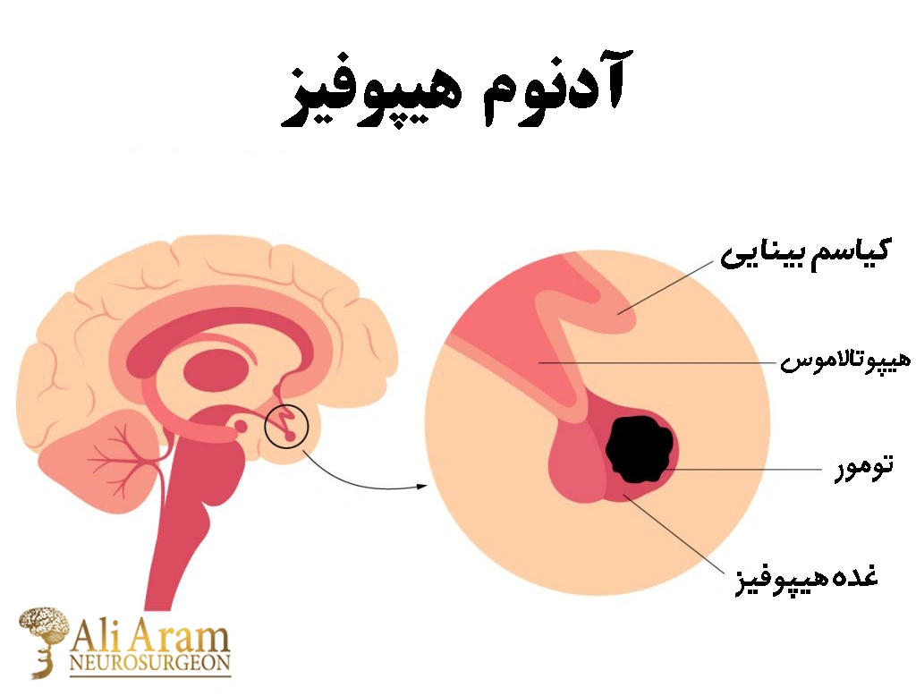 علت‌ها و عوامل آدنوم هیپوفیز