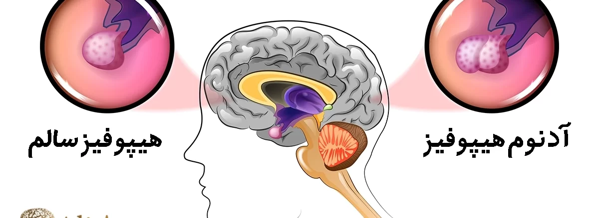 آدنوم هیپوفیز چیست