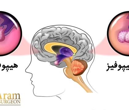 آدنوم هیپوفیز چیست