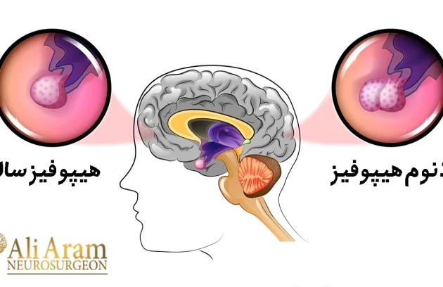 آدنوم هیپوفیز چیست