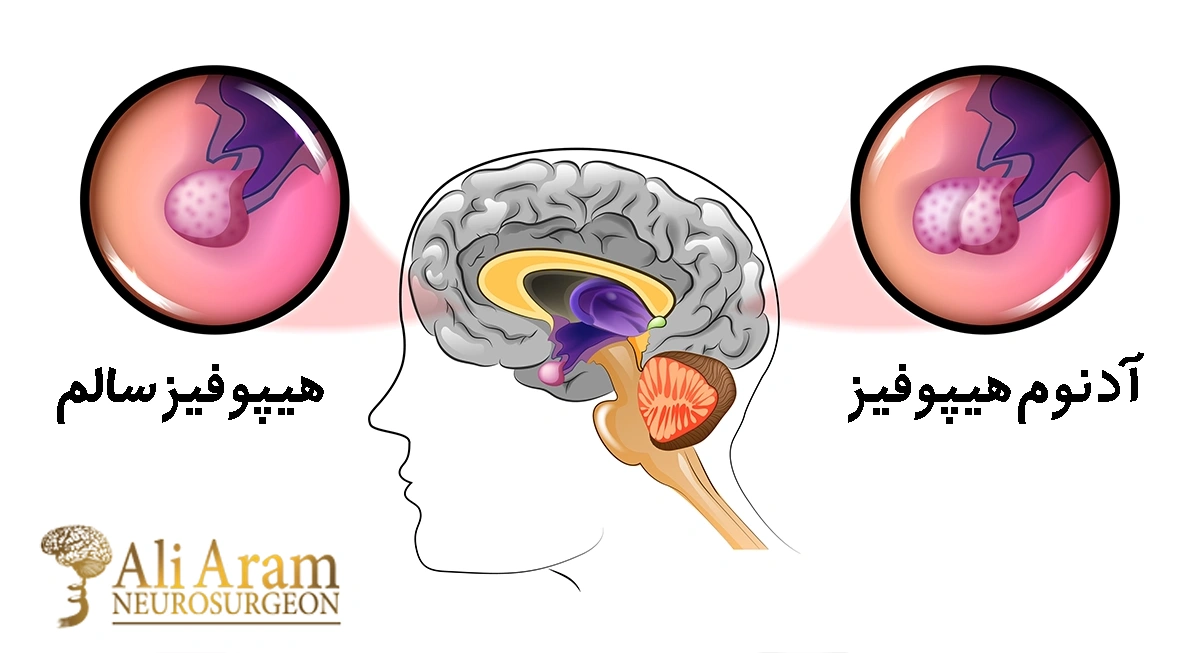 آدنوم هیپوفیز چیست