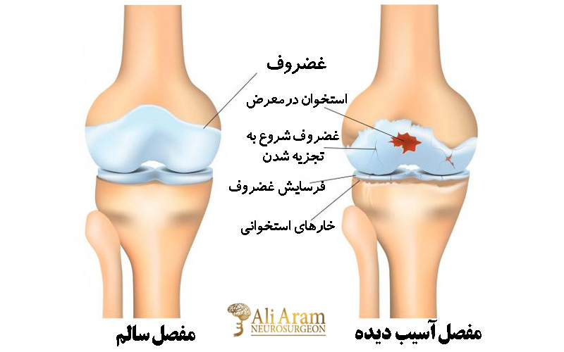 راه‌های پیشگیری و درمان کریپتوس مفاصل