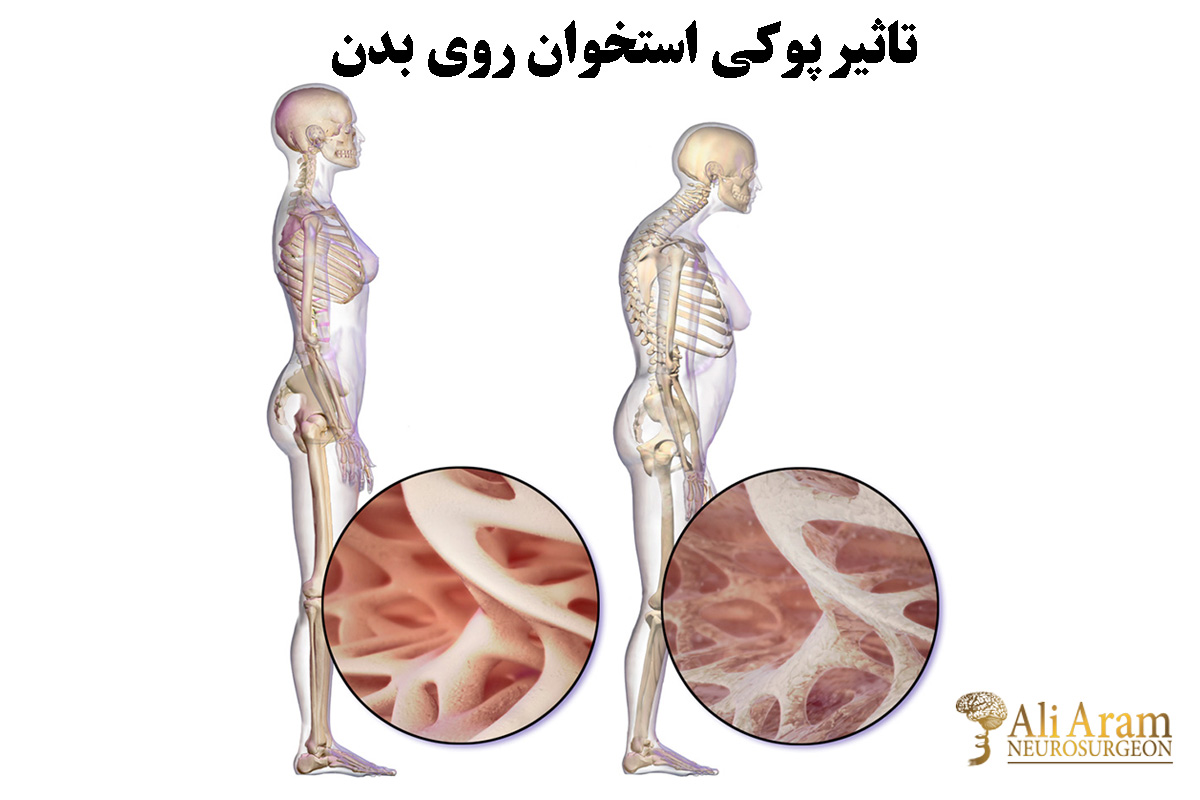 درمان و مدیریت علائم پوکی استخوان