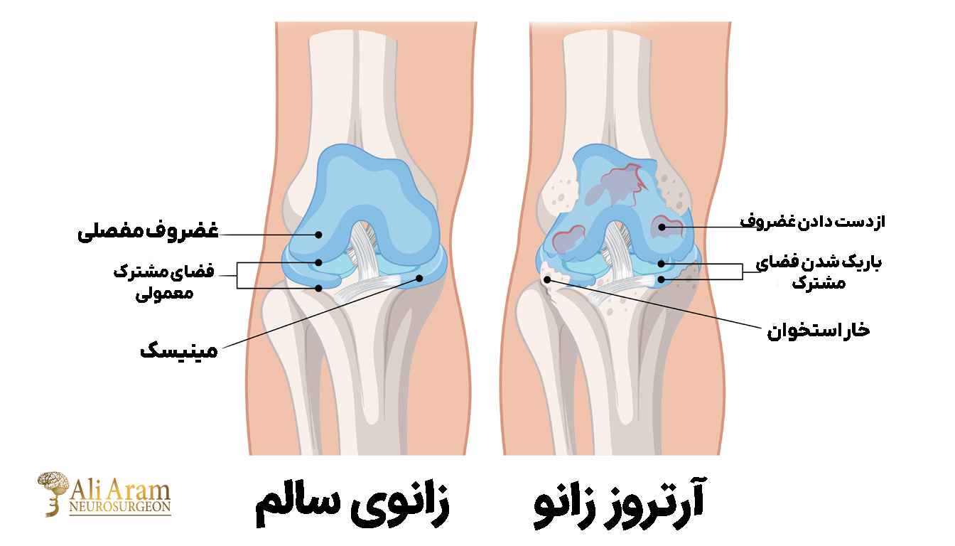 علائم آرتروز زانو