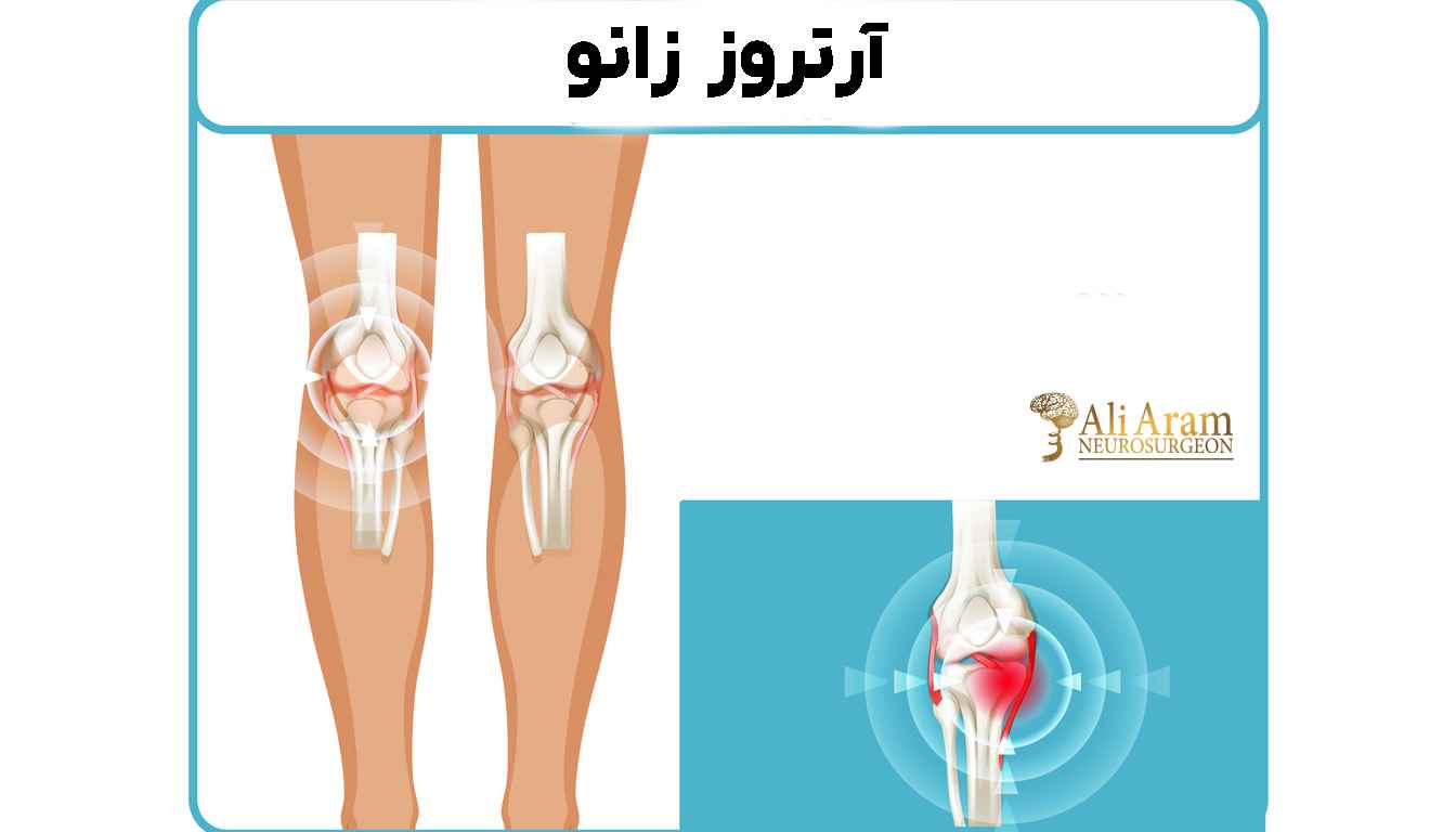 پیشگیری از آرتروز زانو