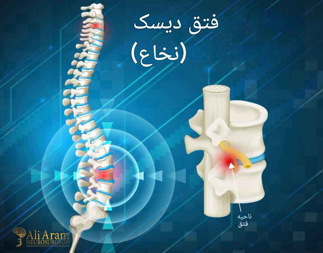 روش‌های تشخیص فتق دیسک