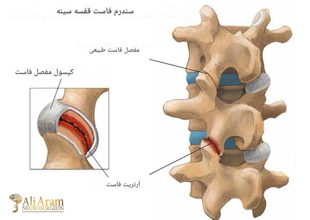 علائم سندرم مفصل فاست