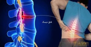 فتق دیسک علائم، روش های تشخیص و درمان
