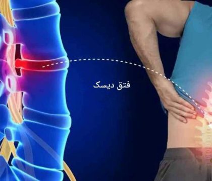 فتق دیسک علائم، روش های تشخیص و درمان