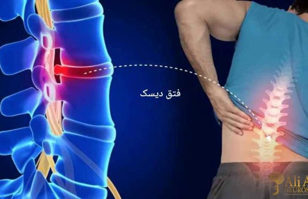 فتق دیسک علائم، روش های تشخیص و درمان